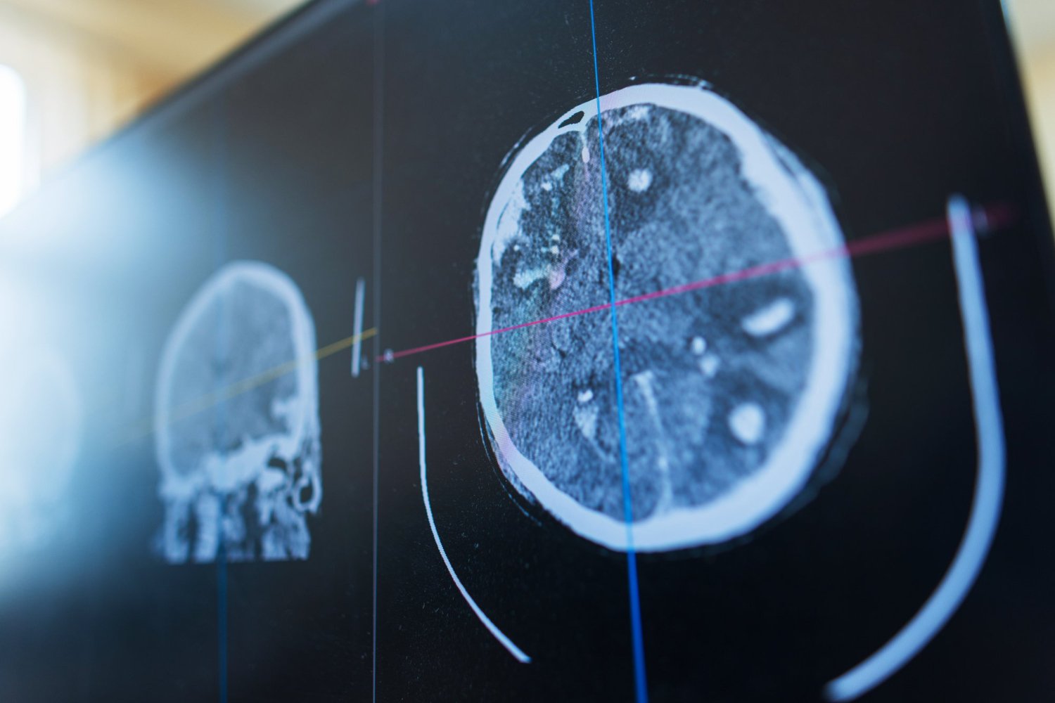 best brain neurosurgeons in Athens