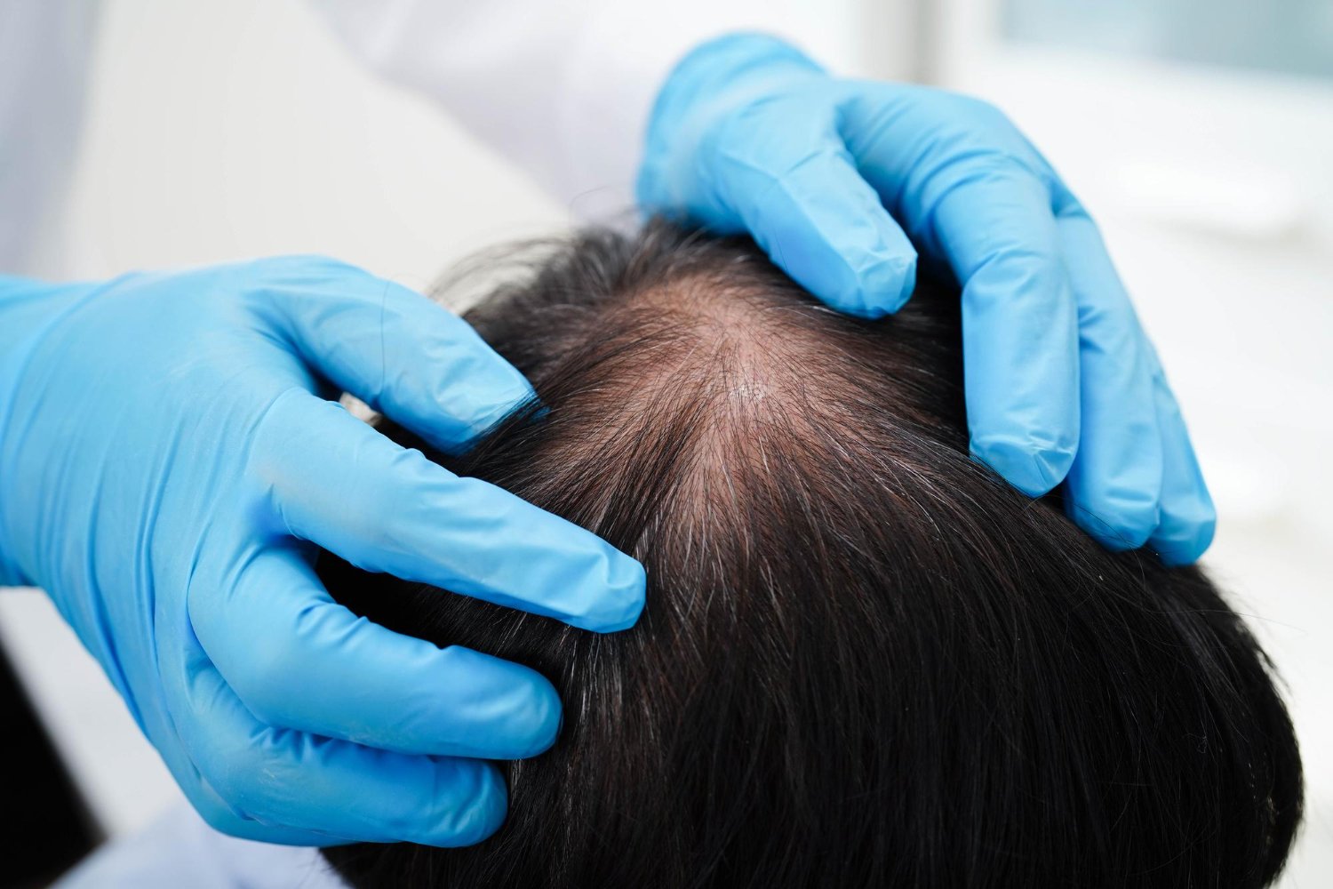 best dermatologists for hair loss in Athens