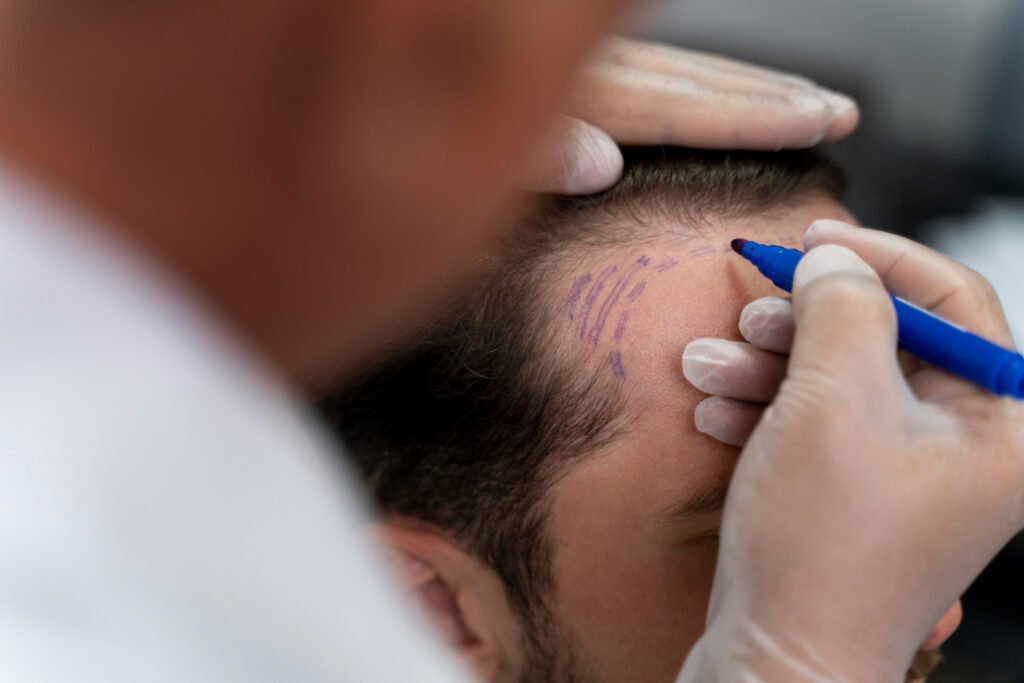 best hair transplant clinic in Athens