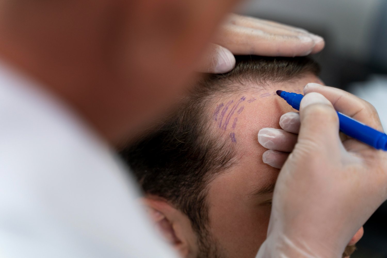 best hair transplant clinic in Athens