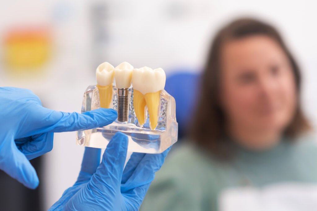 What is the cost of Dental Implants: The Complete Guide